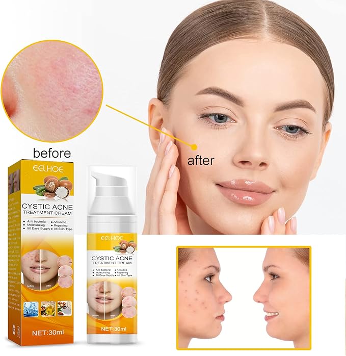 Eelhoe - Cystic Acne Cream (Original)
