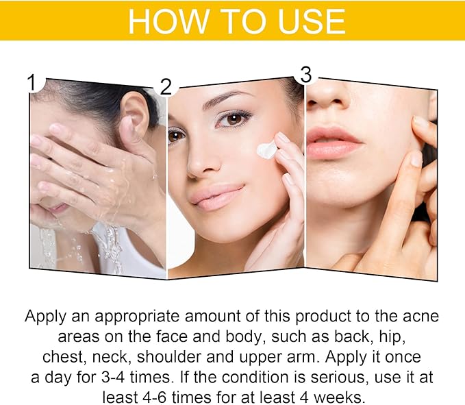 Eelhoe - Cystic Acne Cream (Original)