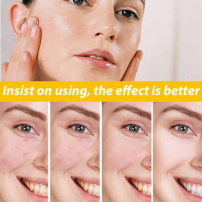 Eelhoe - Cystic Acne Cream (Original)