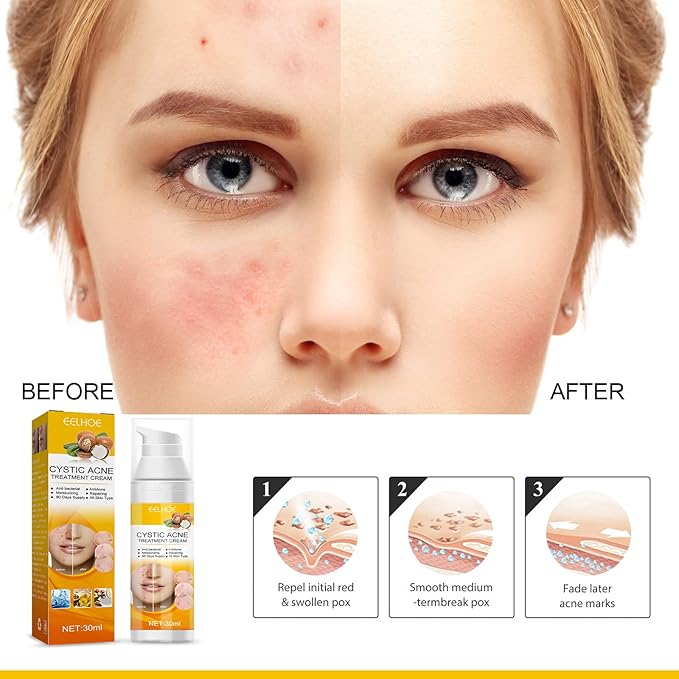 Eelhoe - Cystic Acne Cream (Original)